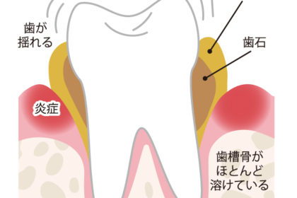 歯周病