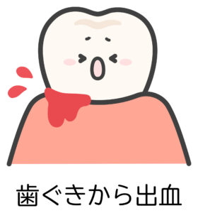 歯茎から血が出る