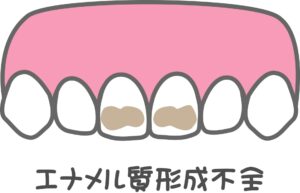 エナメル質形成不全