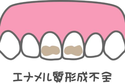 エナメル質形成不全