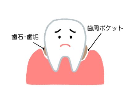 歯周ポケット